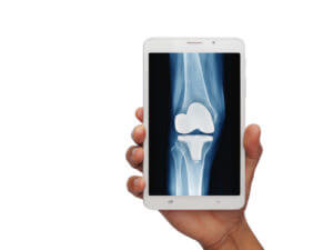 Joint Replacement