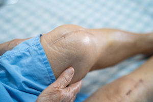 A patient after total knee arthroplasty