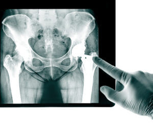 doctor looking at an xray for a hip replacement
