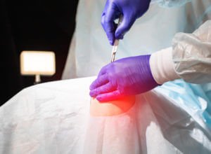 Knee replacement surgery concept photo