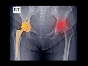 Film X ray DDH and total hip replacement