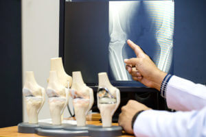 Orthopedic Doctor pointing on the knee problem point on x-ray film