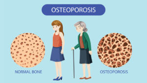 Bone Density and Osteoporosis