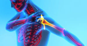 Adult Male Feeling Shoulder Pain. Needs Shoulder Replacement Surgery.