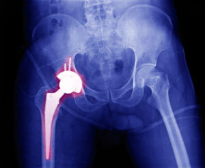 X-ray image showing total Hip joint replacement.