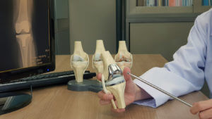Doctor showing implants for a knee replacement for arthritis damage.