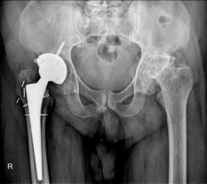 An X-ray of the hip joint and pelvic region of a patient who underwent hip replacement surgery.