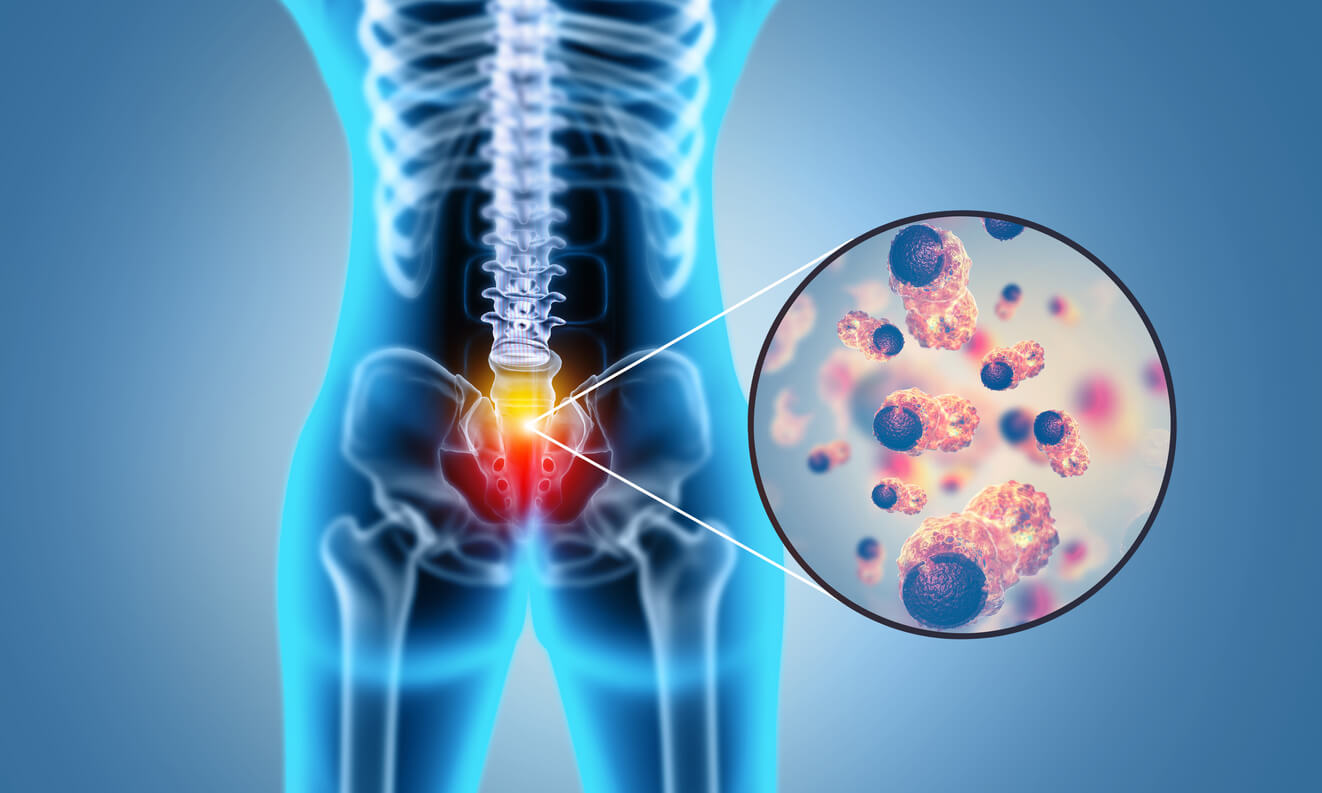 Bulging Disc & Back Pain: 7 Natural Treatments That Work - Dr. Axe