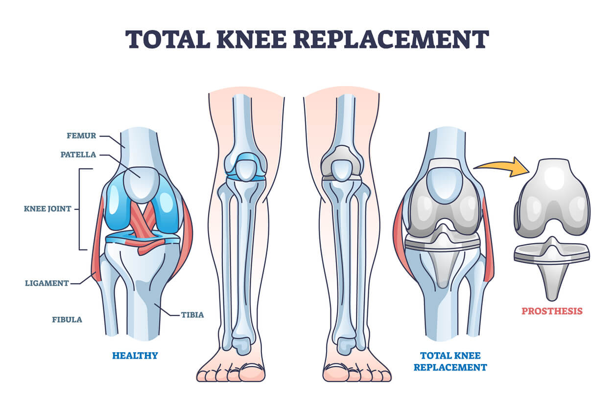 Penggantian Sendi Lutut Total (Total Knee Replacement) - Rumah Sakit ...